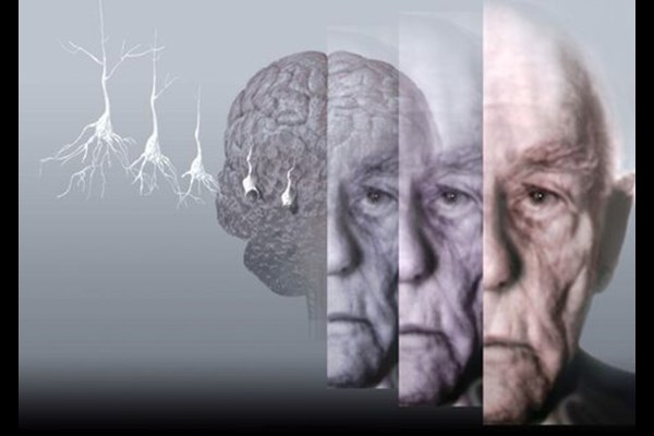 اختلال در حس جهت یابی می‌تواند نشانه اولیه آلزایمر باشد