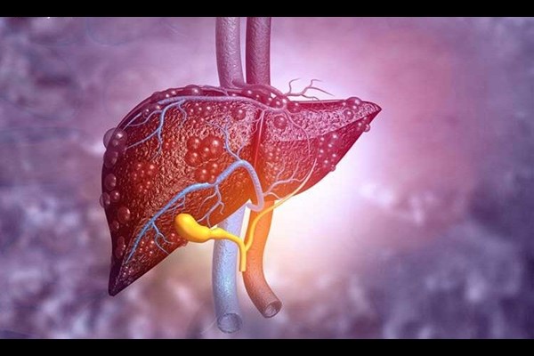 هشدار دفتر بهبود تغذیه جامعه وزارت بهداشت به درمان نادرست کبد چرب