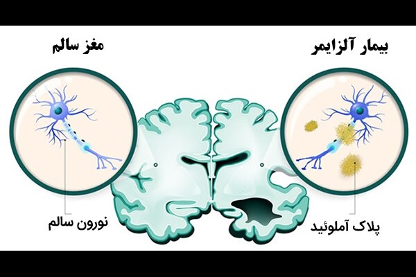 ۲۰۰۰ سال پیش آلزایمر بیماری نادری بود!