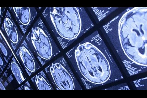 تاثیر پیاده‌روی روزانه بر مهار آلزایمر